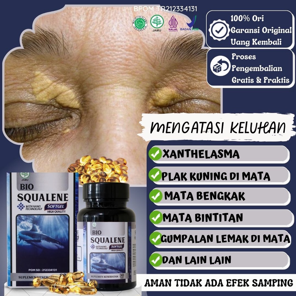 Jual Obat Xanthelasma Penghilang Gumpalan Lemak Di Kelopak Mata Lesi ...