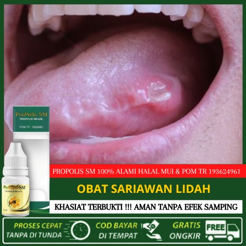 Jual Obat Sariawan Lidah Anak Anak Dan Dewasa, Obat Sariawan Gusi