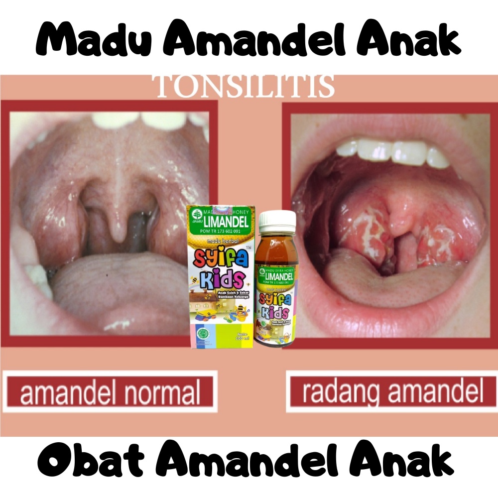 Jual Madu Amandel Anak Obat Radang Tenggorokan Sakit Amandel
