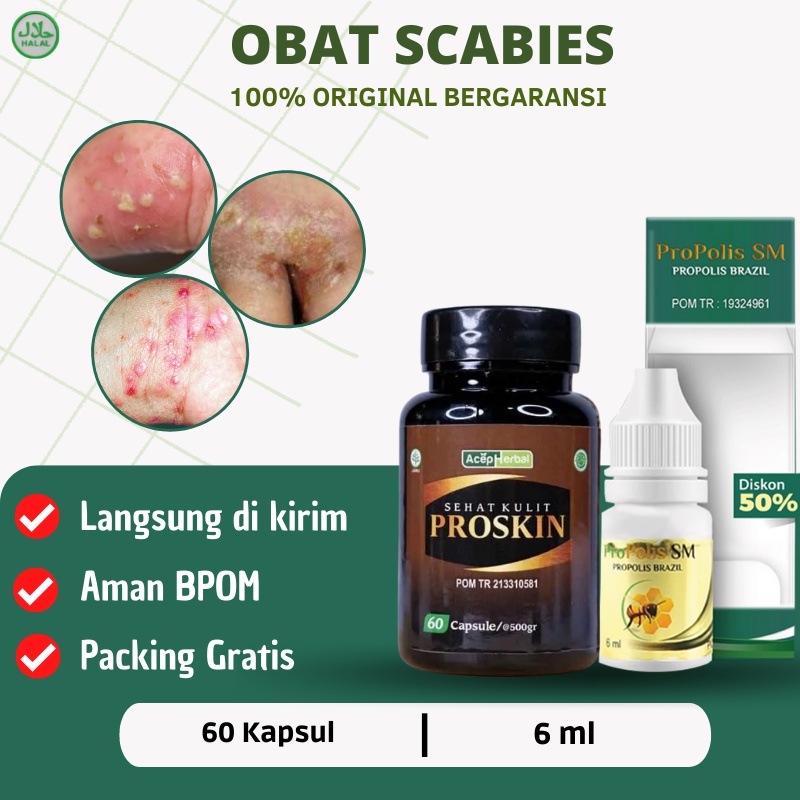 Jual Proskin Obat Scabies Obat Scabies Manusia Salep Scabies Untuk