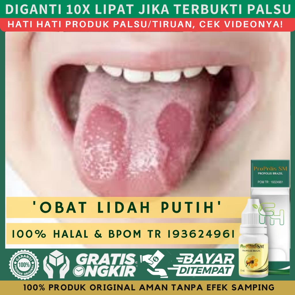 Jual Obat Lidah Putih - Obat Tetes Lidah Putih Pada Anak - Radang Lidah