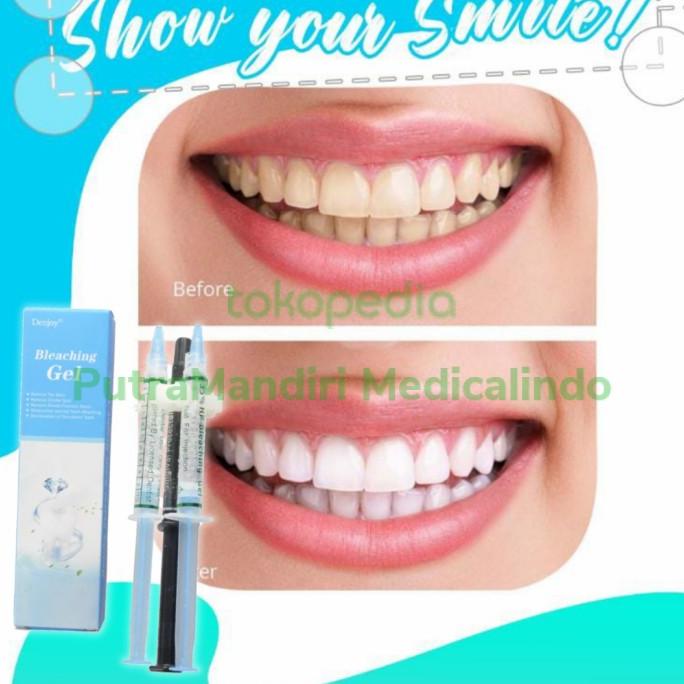 Dennovate Teeth Whitening Gel Pack（DENNOVATE TEETH