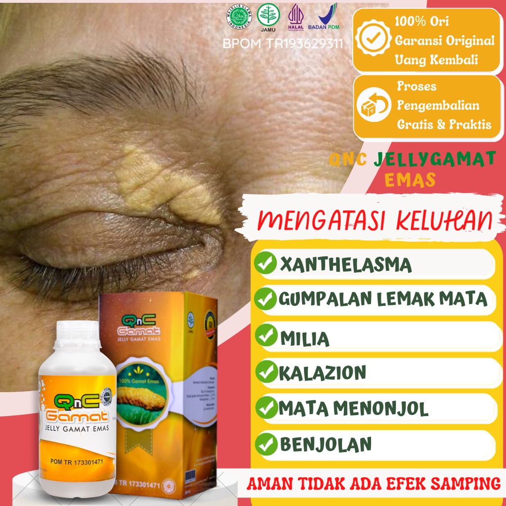 Jual Obat Xanthelasma Penghilang Gumpalan Lemak Di Kelopak Mata ...