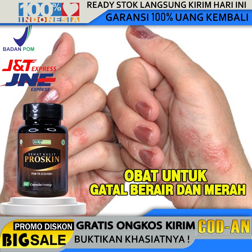 Jual Obat Gatal Berair Di Jari Tangan Dan Kaki Obat Penghilang Bintik Bening Obat Gatal Bintik 3639