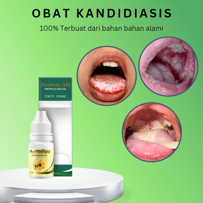 Jual Obat Kandidiasis Mukokutan Obat Pembersih Lidah Obat Lidah Putih Terasa Pahit Obat 4929