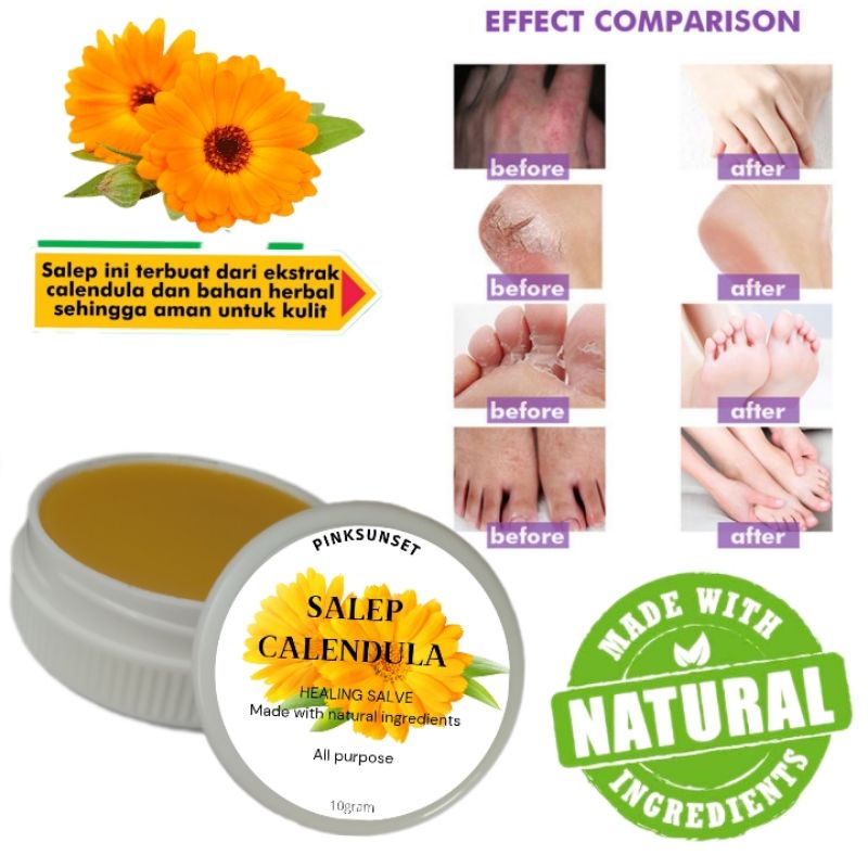 Jual Salep Calendula Healing Salve Salep Obat Gatal Eksim Kering Salep ...