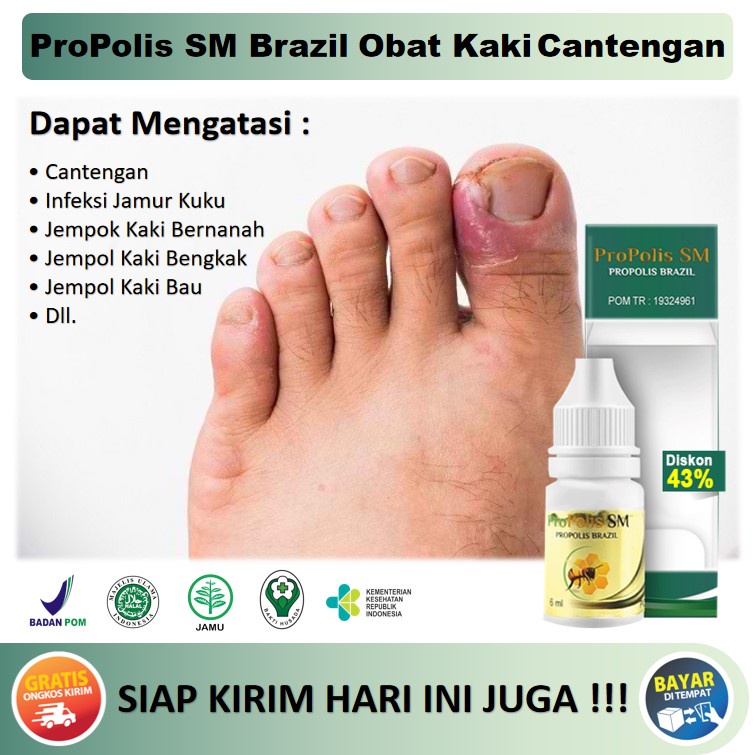 Jual Obat Cantengan Jempol Kaki Kuku Bau Jempol Kaki Bengkak