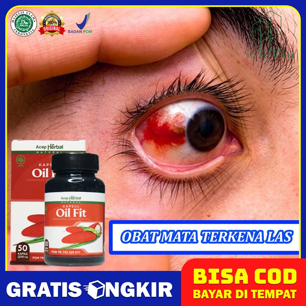 Jual Obat Mata Terkena Las Habis Ngelas Mata Sakit Kena Asap Las