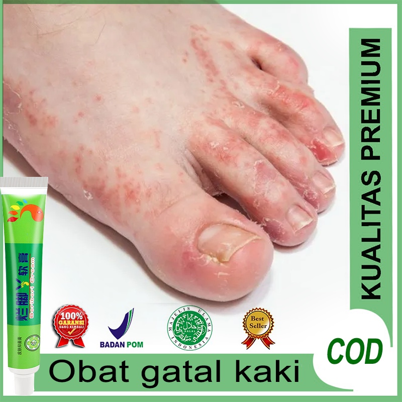 Jual Obat Gatal Kaki 20g Obat Budug Bernanah, Eksim, Herpes, Cenang ...