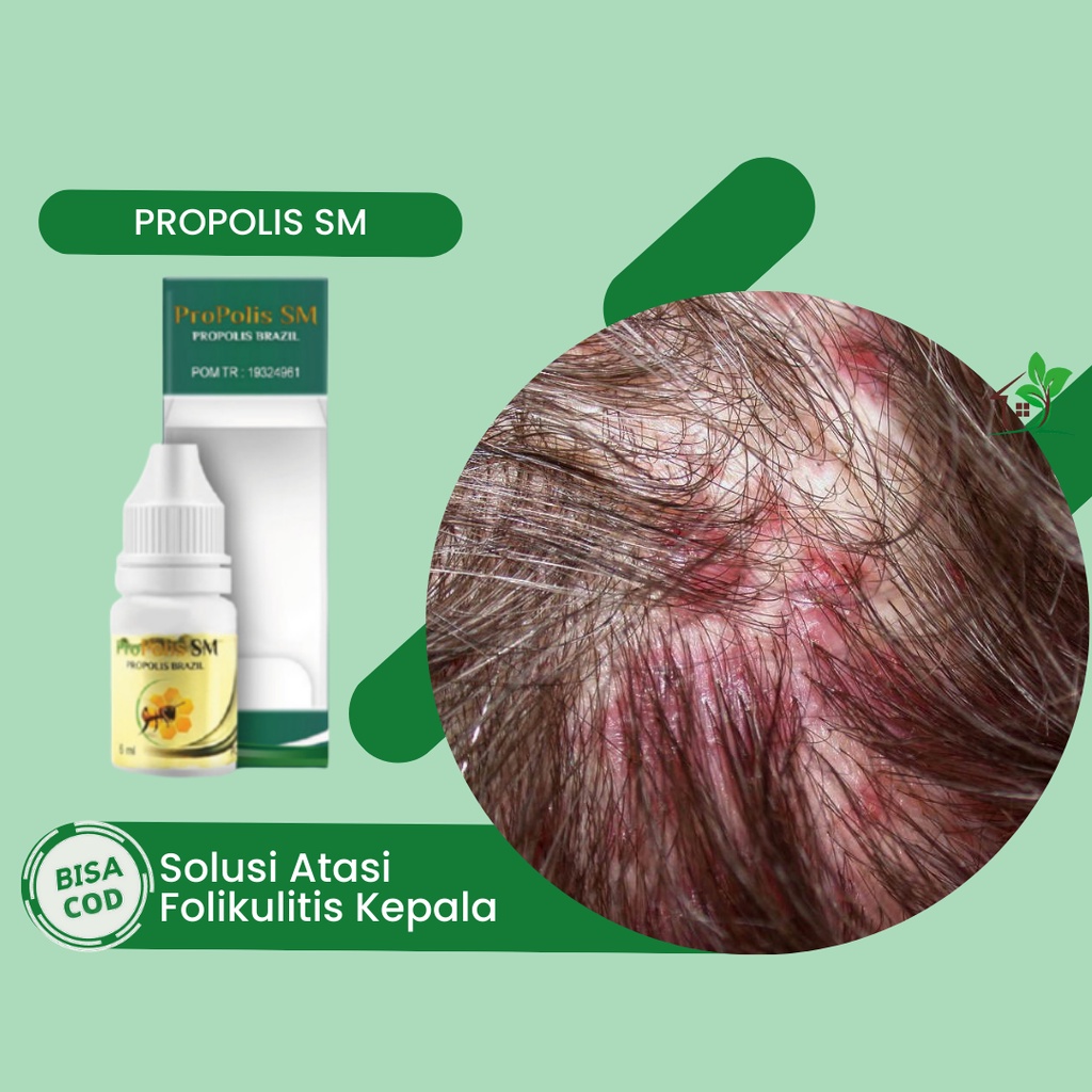 Jual Obat Folikulitis Di Kepala Peradangan Folikel Rambut Infeksi Jamur Kulit Kepala Obat 