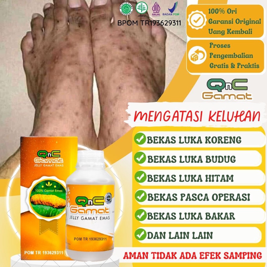 Jual Qnc Jelly Gamat Herbal Alami Obat Luka Koreng Di Kaki Penghilang Bekas Budug Hitam Luka