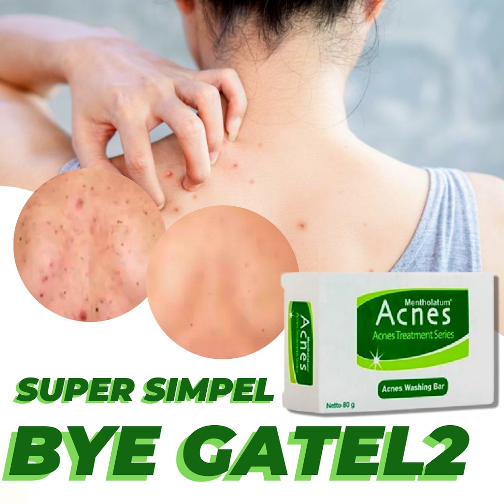 Jual Sabun Acnes Jerawat Punggung Dan Dada Obat Penghilang Jerawat Dan