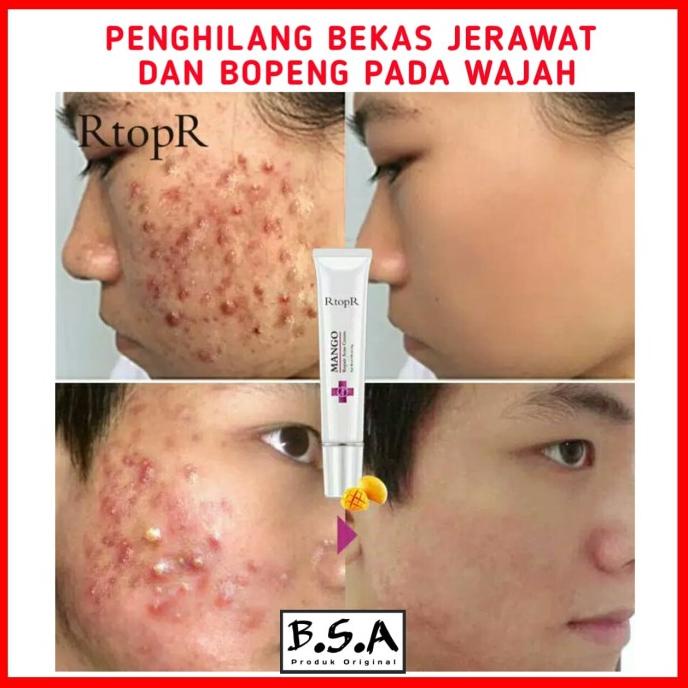 Jual (BISA COD) CREAM PENGHILANG JERAWAT DAN BEKASNYA (BOPENG) | Shopee