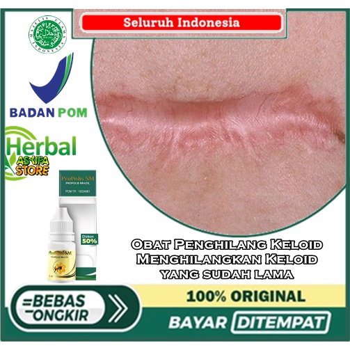 Jual Obat Penghilang Keloid, Menghilangkan Keloid yang sudah lama ...