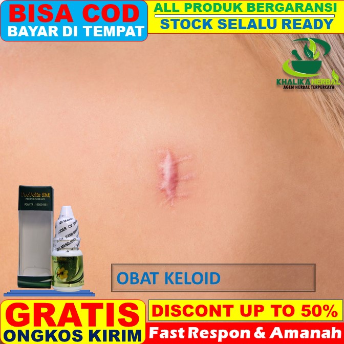 Jual obat keloid obat keloid menahun obat keloid Obat Keloid, Obat
