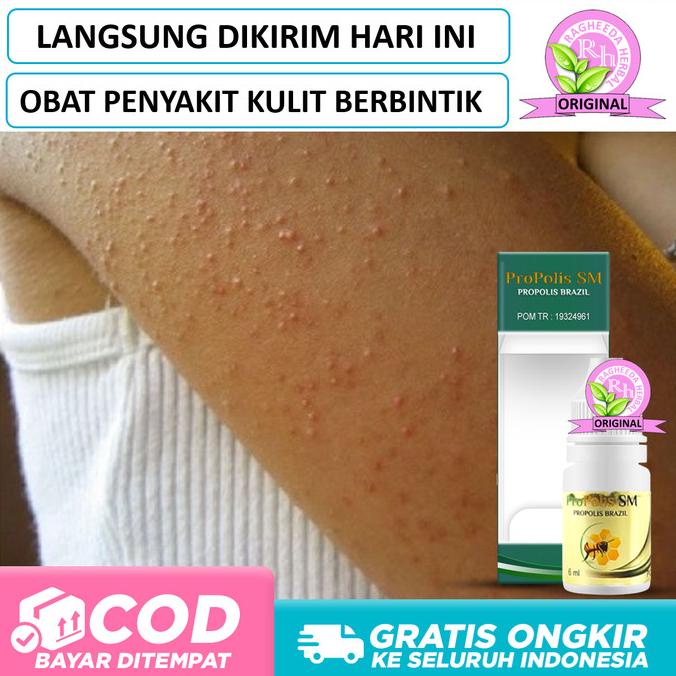 Jual Obat Keratosis Pilaris Penyakit Kulit Ayam Berbintik Bercak