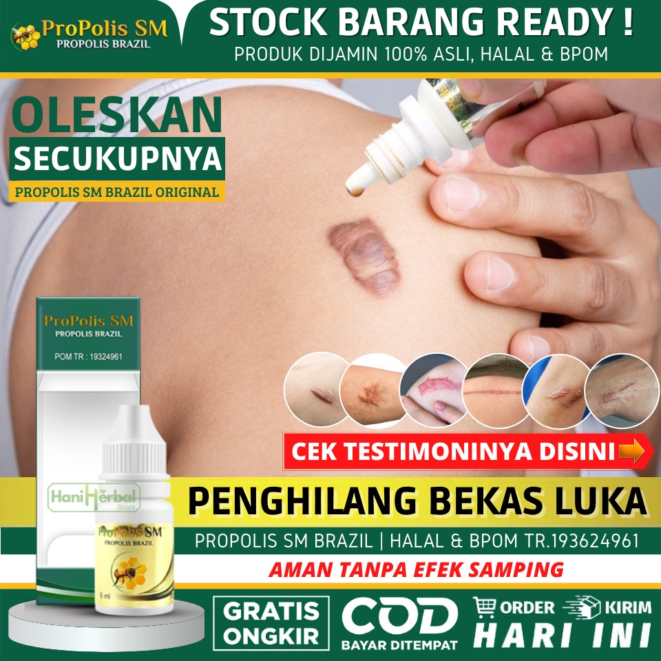Jual Obat Oles Penghilang Keloid / Daging Menonjol Bekas Luka - Keloid ...