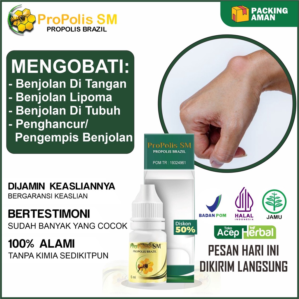 Jual Obat Benjolan Di Tangan Kista Ganglion Pengempis Benjolan Di ...