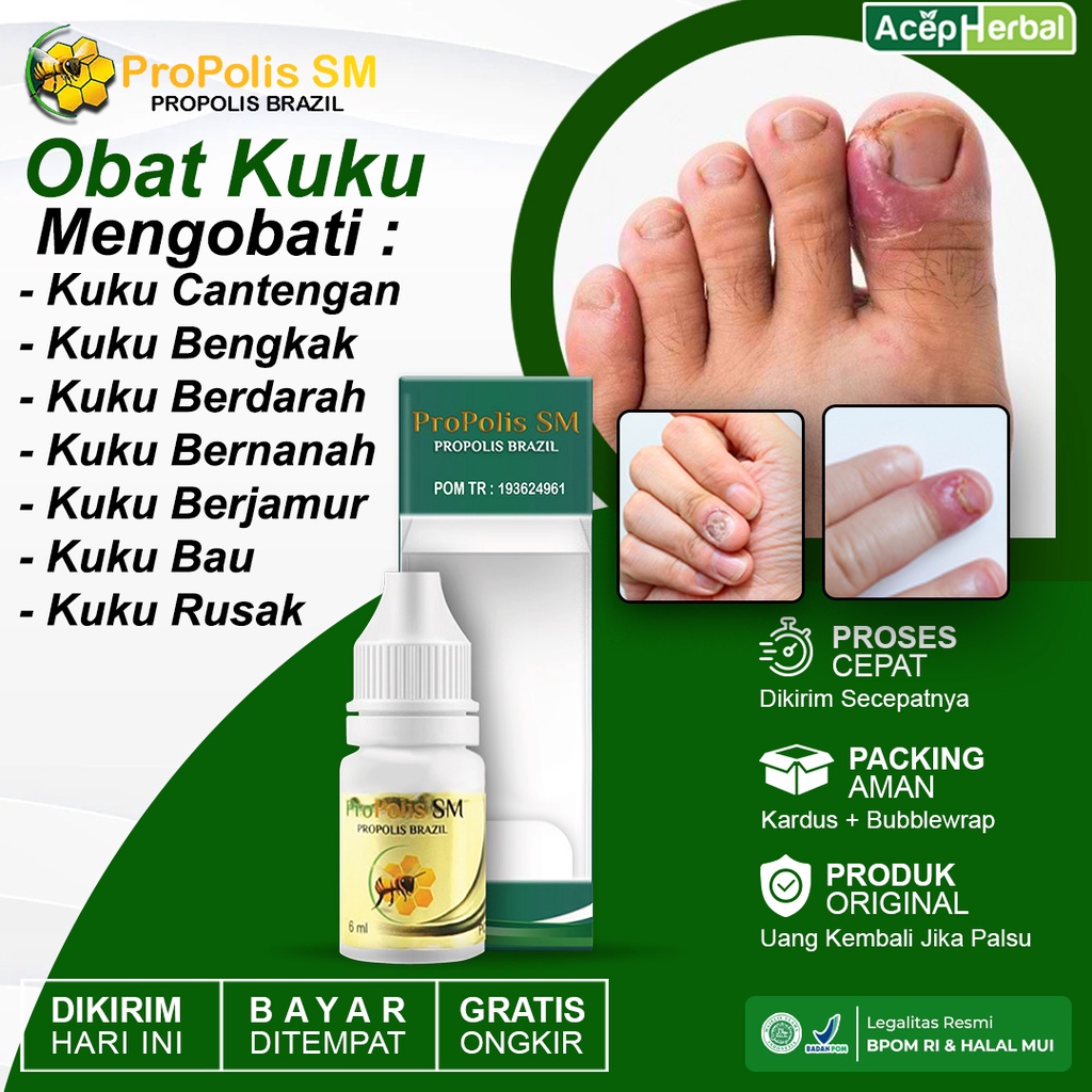 Jual Obat Cantengan Jempol Kaki Kuku Rusak Bengkak Bernanah Berdarah