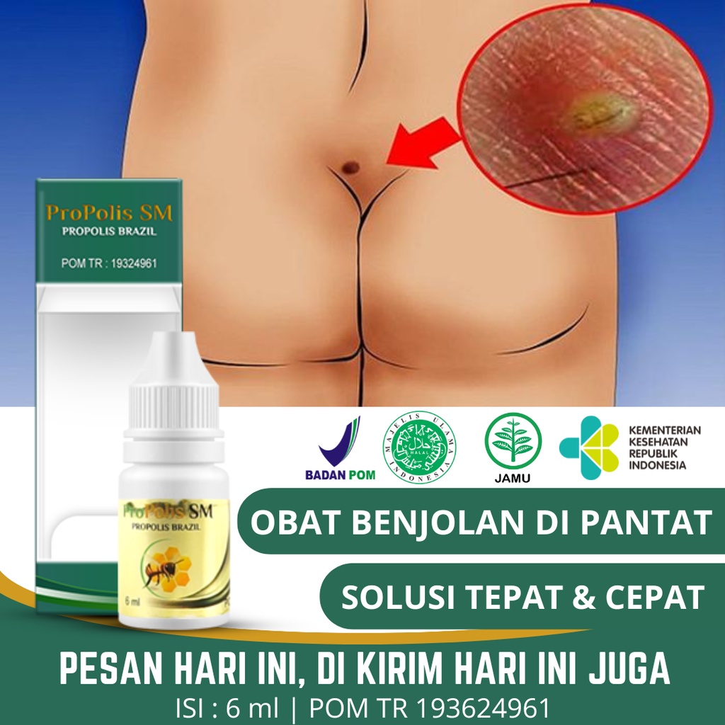 Jual Obat Benjolan Di Pantat Obat Gatal Di Pantat Obat Benjolan Di Bokong Obat Fistula Ani