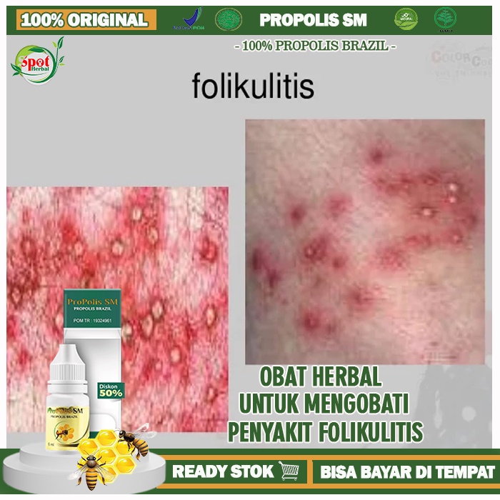 Jual Obat Folikulitis Alami Infeksi Jamur Bakteri Di Kulit Kepala Obat Gatal Folikulitis Obat 