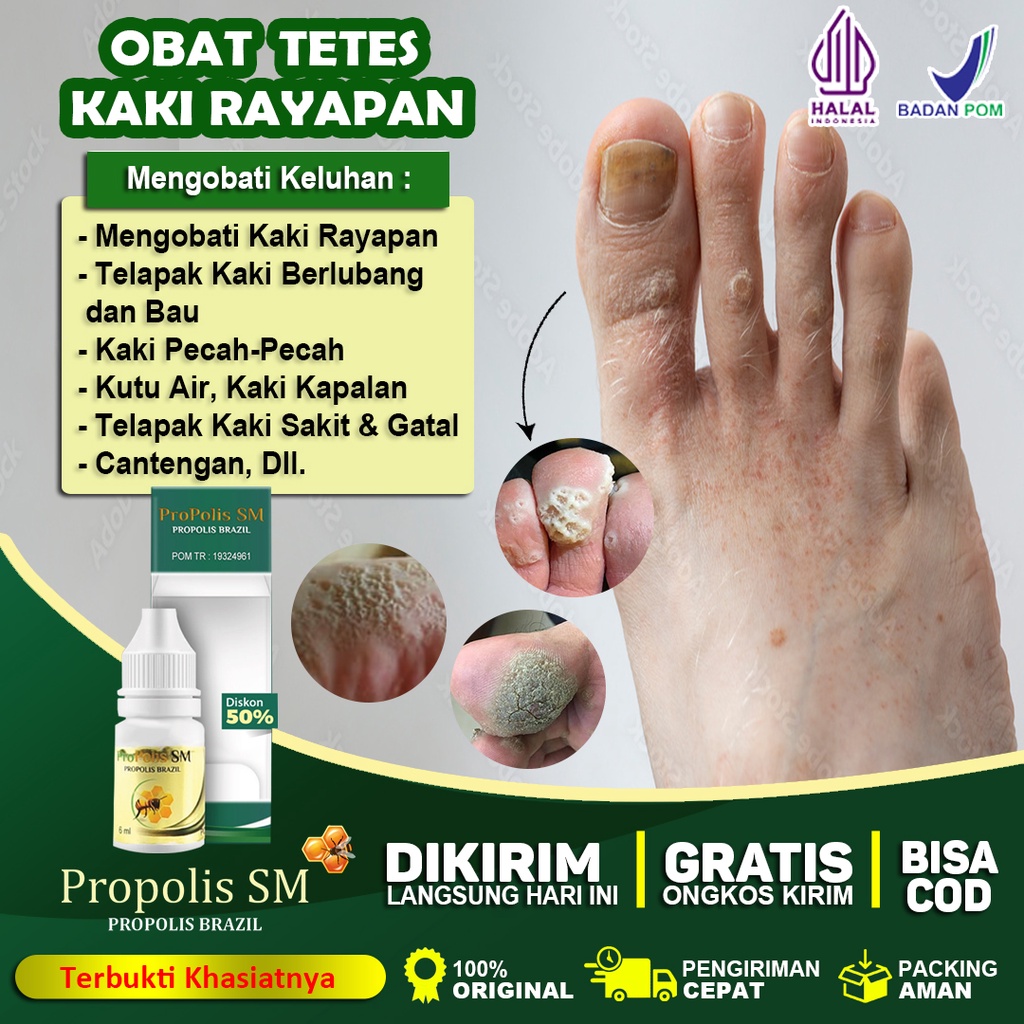 Jual Obat Kaki Rayapan Telapak Kaki Bolong Salep Kaki Rayapan Telapak ...