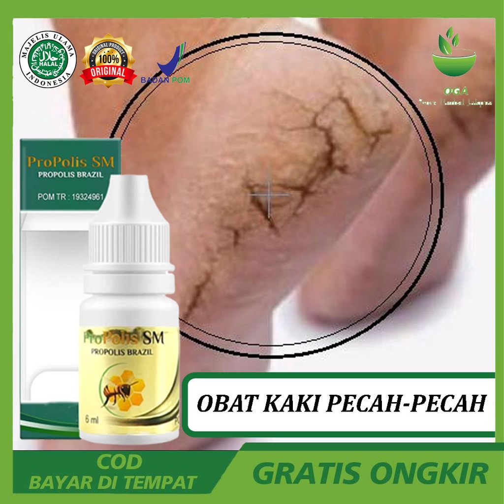 Jual Obat Penghilang Kaki Pecah Penghilang Mata Ikan Telapak Kaki Dan Tangan Terlaris Di Jakarta