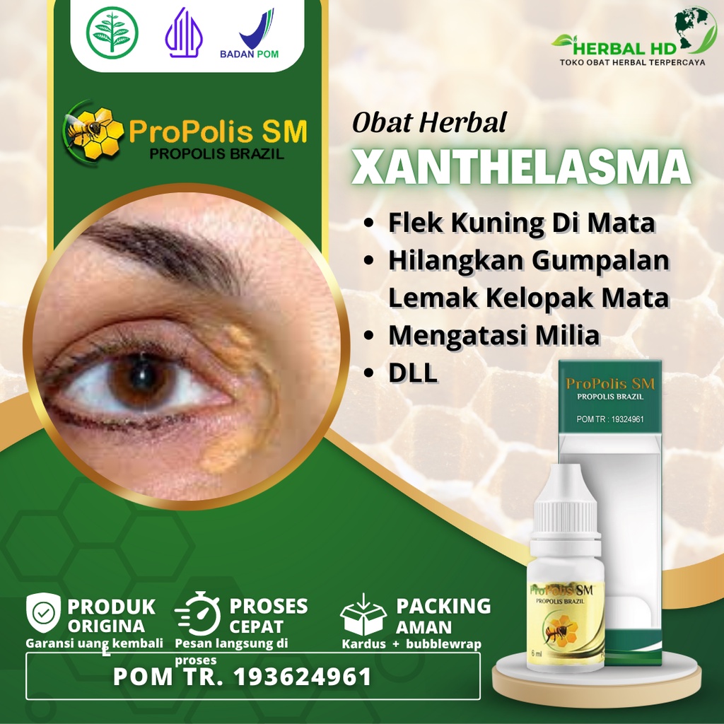 Jual Obat Xanthelasma, Gumpalan Lemak Di Kelopak Mata, Gumpalan Lemak ...