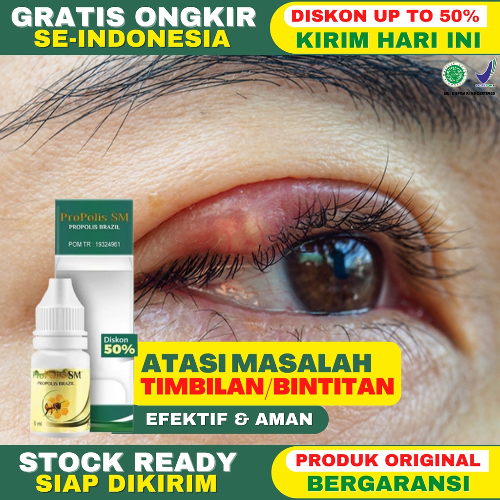 Jual Obat Mata Timbilan Bintitan Benjolan Di Kelopak Mata Atas Kelopak ...