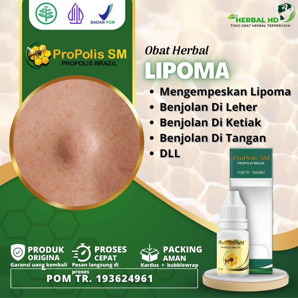 Jual SOLUSI OBAT OLES PENGHILANG BENJOLAN LIPOMA DI TANGAN | PUNGGUNG ...