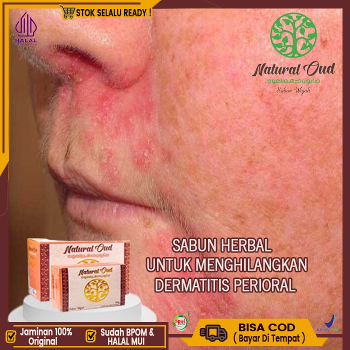 Jual Sabun Untuk Dermatitis Perioral Sabun Untuk Kulit Gatal Kering Sabun Natural Oud