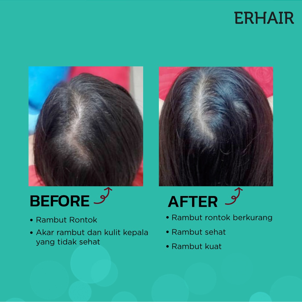 Jual ERHA ERHAIR HAIRGROW SERUM HAIR GROW PERTUMBUHAN KESUBURAN AKAR ...