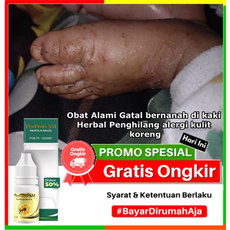 Jual Obat Alami Gatal Bernanah Di Kaki Herbal Penghilang Alergi Kulit