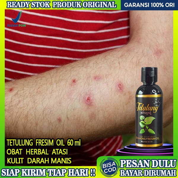 Jual Obat Prurigo Darah Manis Obat Kaki Koreng Fresim Oil 60ml Obat