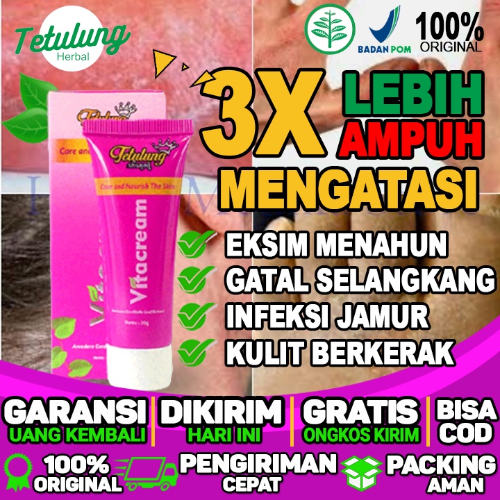 Jual Obat Salep Gatal Pada Kulit Eksim Menahun Dan Infeksi Jamur Yang