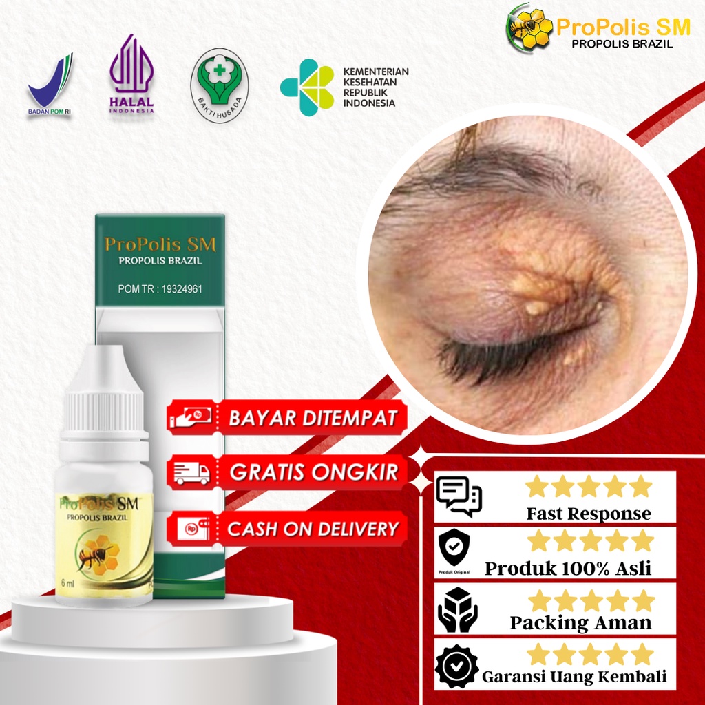 Jual Obat Xanthelasma, Penghilang Gumpalan Lemak Di Kelopak Mata, Obat