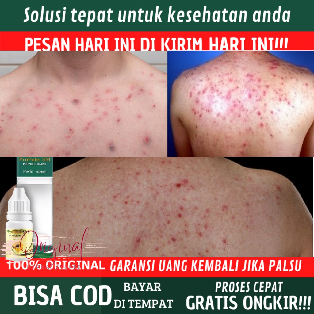 Jual Obat Jerawat di punggung, Obat Jerawat punggung dan dada, Obat