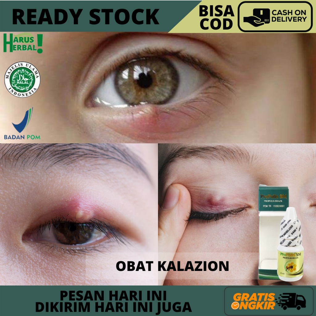 Jual Obat Kalazion Mata, Pengempis Benjolan Di Kelopak Mata, Obat Oles ...