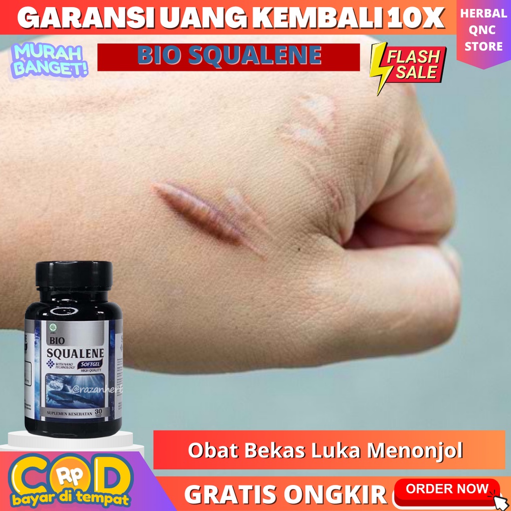 Jual Obat Bekas Luka Menonjol Obat Penghilang Keloid Berkerut