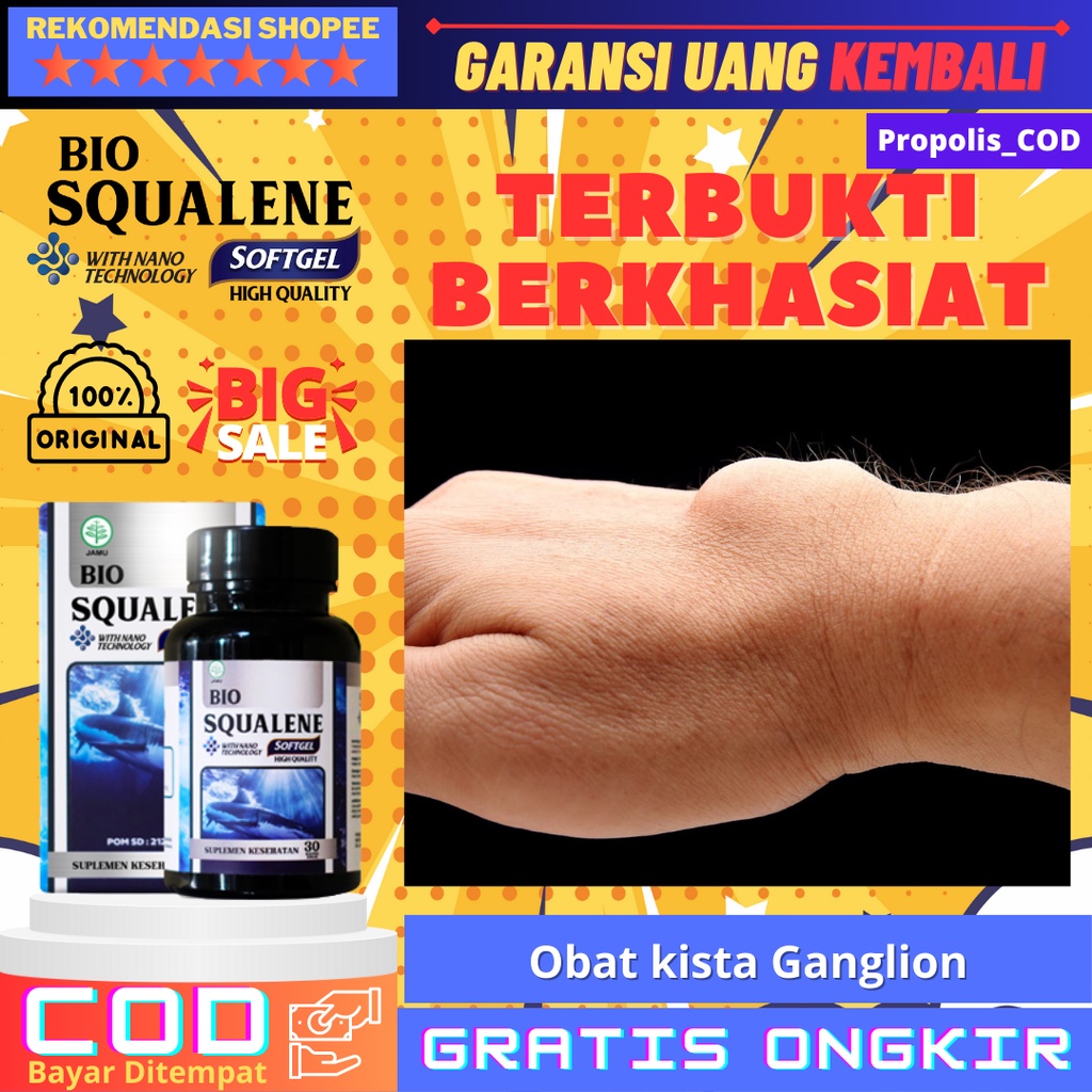 Jual Obat Kista Ganglion, Benjolan Di Tangan, Kista Hygroma, Tumor ...