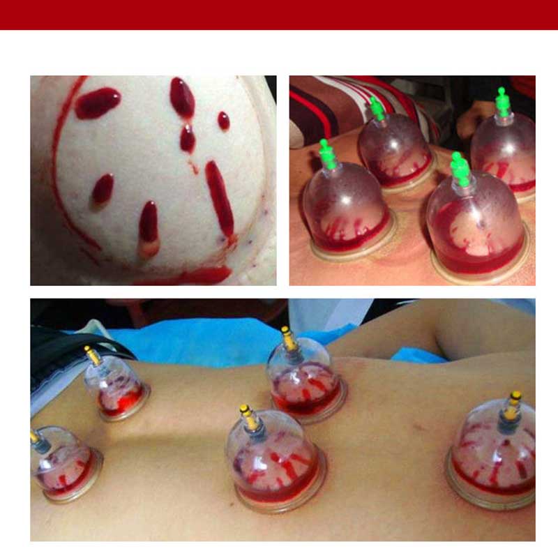 Jual Pen Bekam Otomatis / Pena Runcing Lancing Darah / Pena Kop Bekam ...