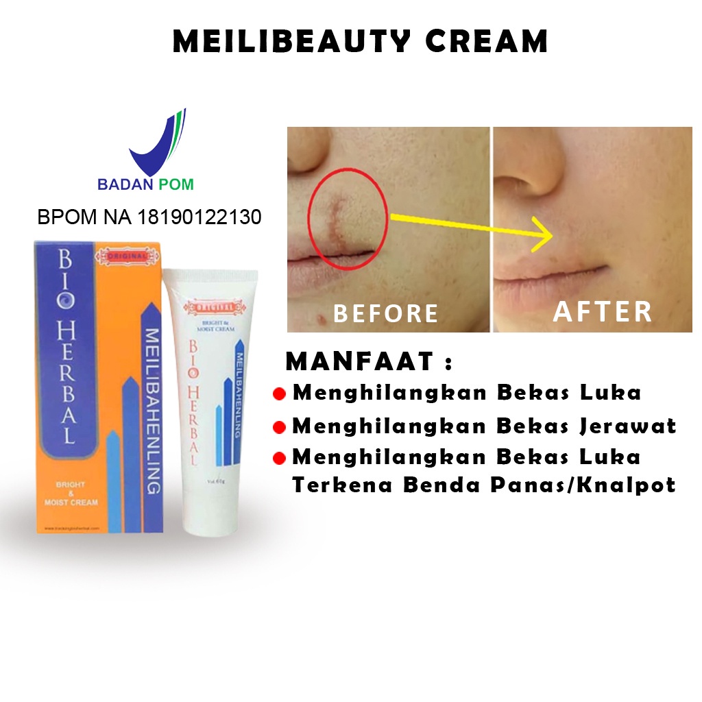 Jual Penghilang Bekas Luka Hitam Jerawat Koreng dan Keloid Salep Krim