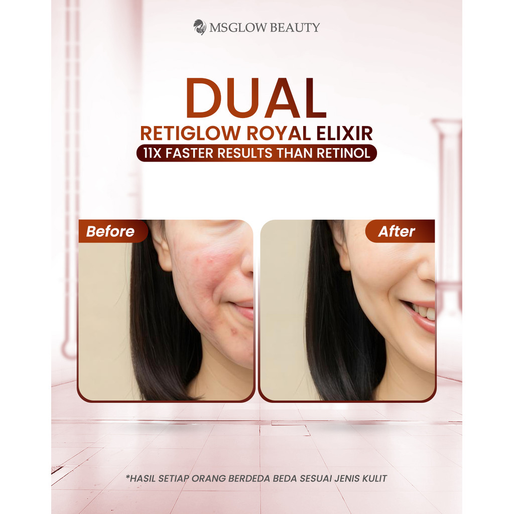 Jual MS GLOW Dual Retiglow Royal Elixir Penghilang Bekas Noda Hitam ...