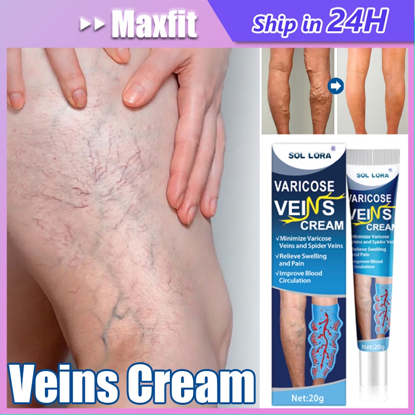 Jual Varicose Veins Cream Obat Varises Di Kaki Dan Betis Paling Ampuh Salep Varises G Salep