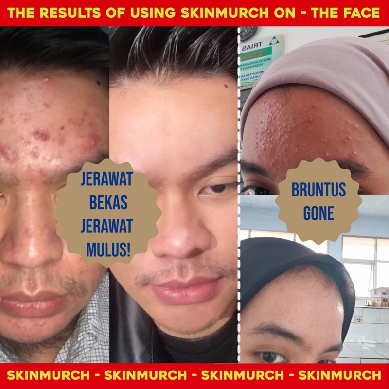 Jual SKINMURCH Multi Action Treatment Cream si endog Skinmurch Skin ...