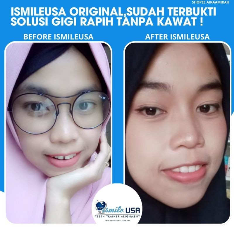 Jual Alat Perapih Gigi Maju Tonggos Ismile USA Original 100% Garansi ...
