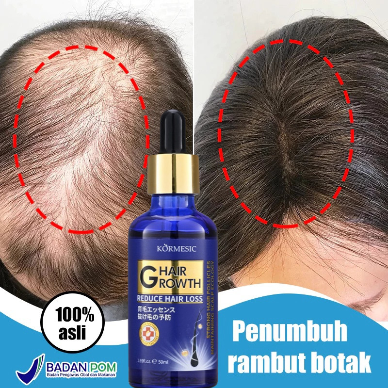 Jual KORMESIC Serum Penumbuh Rambut Botak 50ml Rosemary Oil Rambut Obat ...