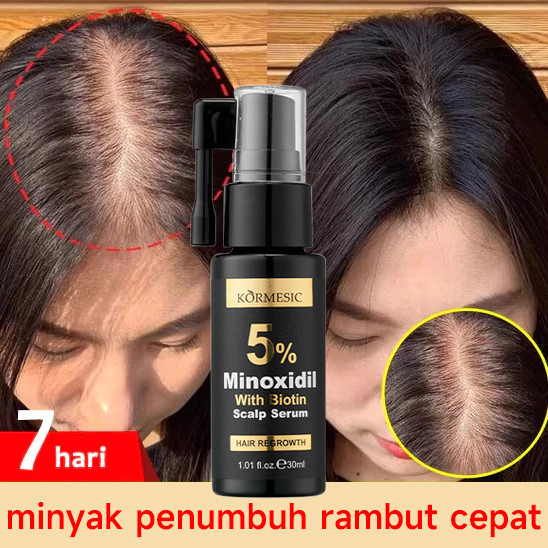 Jual Minoxidil 5% Penumbuh Rambut Obat Penumbuh Rambut Botak, Tipis Dan ...