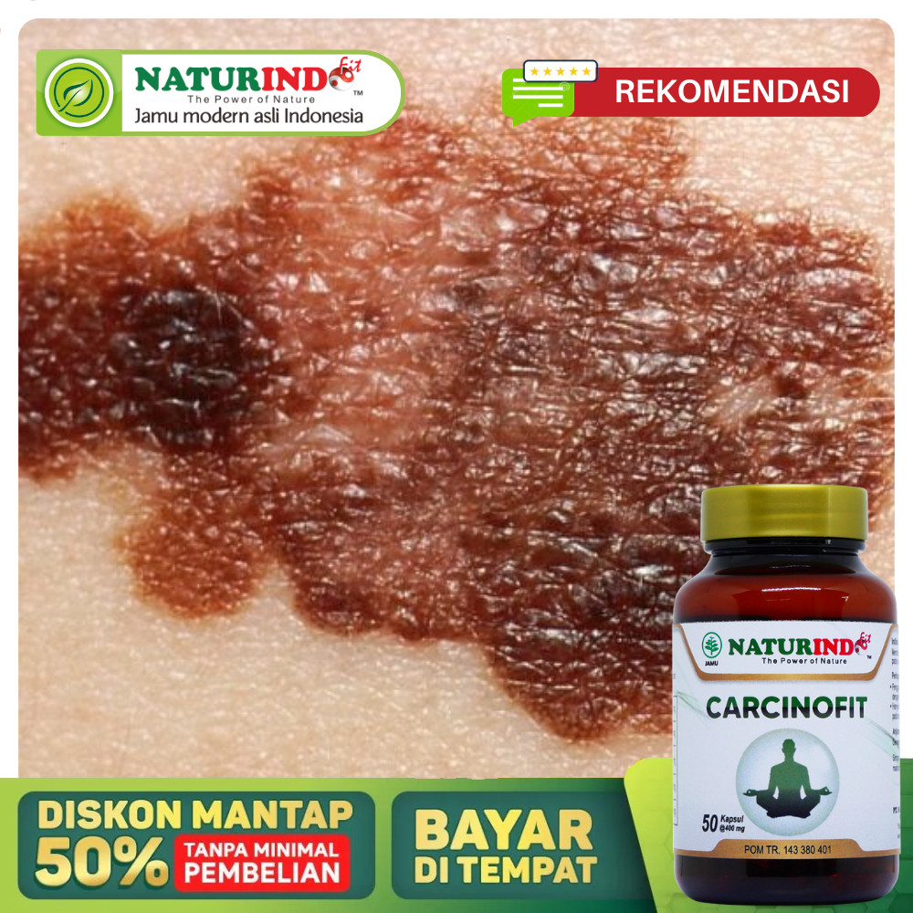Obat Kanker Kulit Paling Ampuh, Obat Kanker kulit Melanoma, Obat Penghilang Kanker Kulit, Obat Benjolan Bercak di Kulit, Obat Kanker Kulit Karsinoma Sel Basal, Obat Kanker Kulit Sel Skuamosa, Penyakit Epidermis - Carcinofit Naturindo