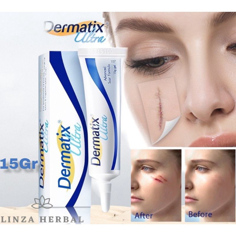 Jual COD Dermatik Ultra / Dermatic / Dermatix Ultra 15Gr Cream Krim ...
